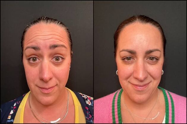 Daxxify (Botox alternative)  Case 11