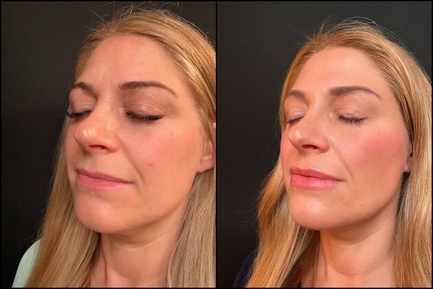 Dermal Fillers: Case 2 - Facial Fillers & Xeomin - Before & After