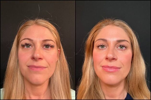 Dermal Fillers Case 2 - Facial Fillers & Xeomin 