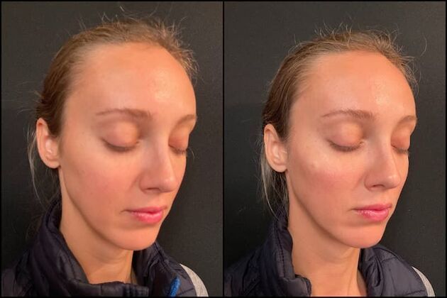 Dermal Fillers Case 4 - Cheek Filler 