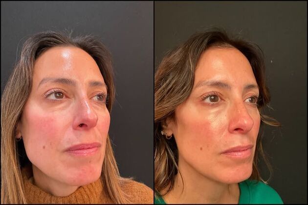 Dermal Fillers Case 5 - Smile Lines Filler