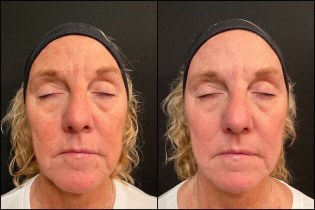 Laser Skin Rejuvenation Cases