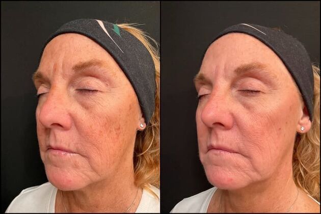 Laser Skin Rejuvenation : Case 1 - NA