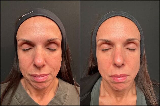 Laser Skin Rejuvenation  Case 2 - Lasemd Ultra Fractional Resurfacing 