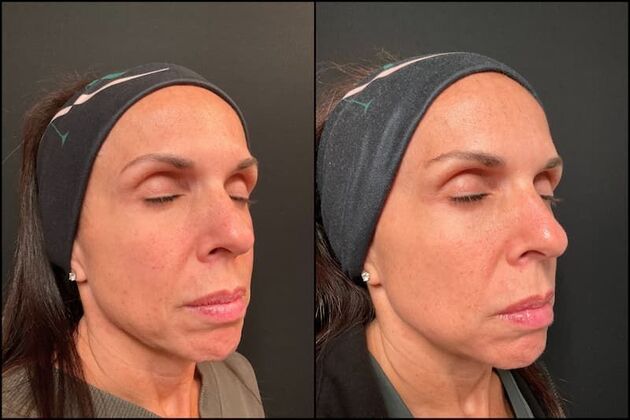 Laser Skin Rejuvenation : Case 2 - Lasemd Ultra Fractional Resurfacing - Before & After