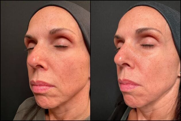 Laser Skin Rejuvenation : Case 2 - Lasemd Ultra Fractional Resurfacing - Before & After