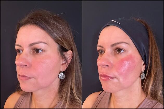 Dermal Fillers Case 6 - Cheek and Lip Fillers