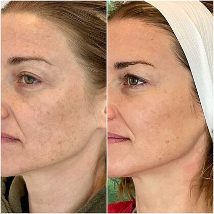 Laser Skin Rejuvenation  Case 3 - LaseMD Ulta Fractional Resurfacing