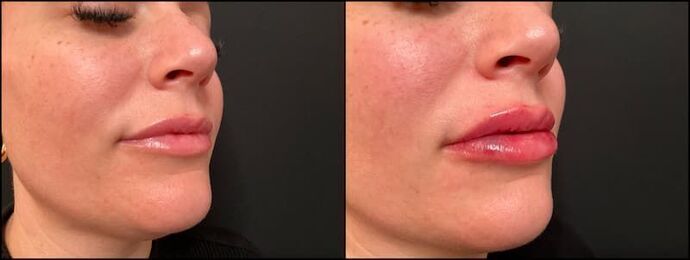 Fillers: Case 9 - Lip Filler - Before & After