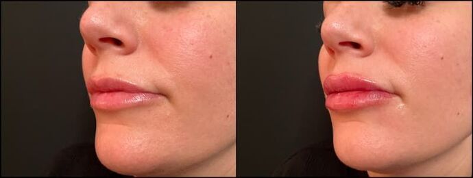 Fillers: Case 9 - Lip Filler - Before & After