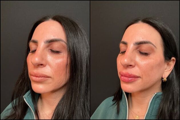 Fillers: Case 10 - Lip Filler - Before & After
