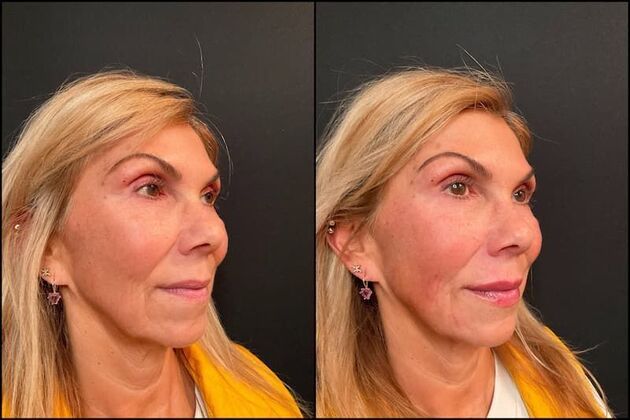 Dermal Fillers Case 12 - Lip Filler 