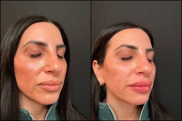 Fillers: Case 10 - Lip Filler - Before & After