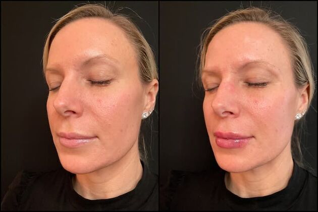 Dermal Fillers Case 14 - Lip Filler 