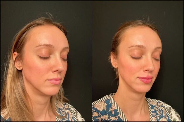 Dermal Fillers Case 15 - Lip Filler 