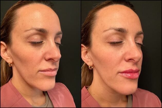 Fillers: Case 16 - Lip Filler - Before & After