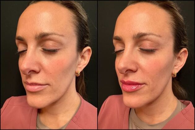 Fillers: Case 16 - Lip Filler - Before & After