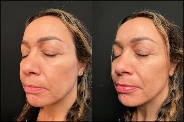 Dermal Fillers Case 17 - Lip Filler 