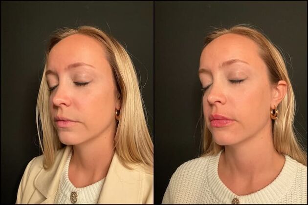 Fillers: Case 18 - Lip Filler - Before & After