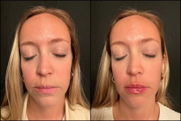 Fillers: Case 18 - Lip Filler - Before & After