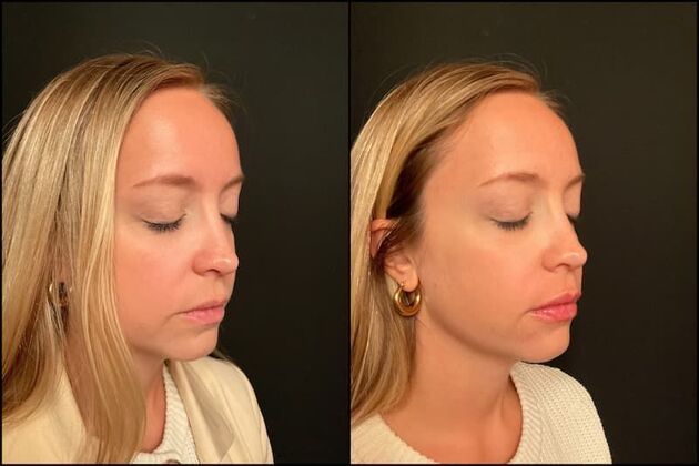 Fillers: Case 18 - Lip Filler - Before & After