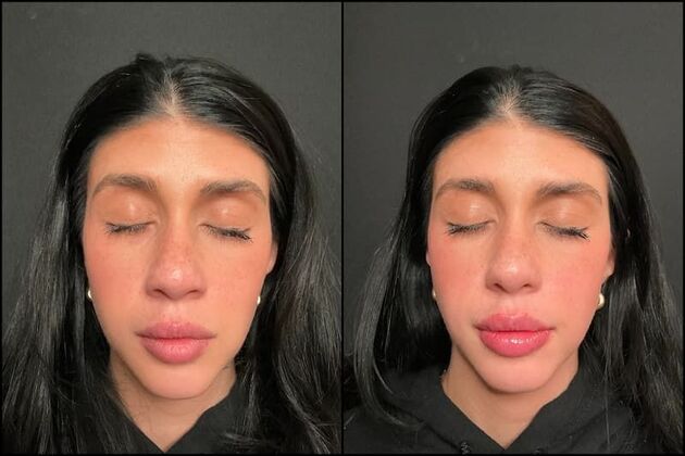 Fillers: Case 19 - Lip Filler - Before & After