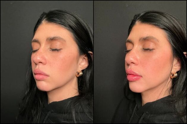 Fillers: Case 19 - Lip Filler - Before & After