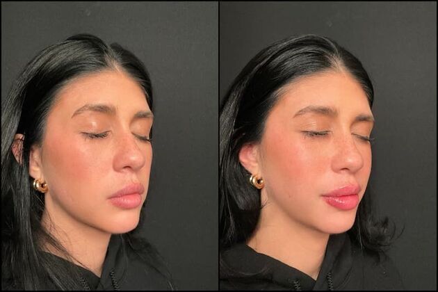 Fillers: Case 19 - Lip Filler - Before & After