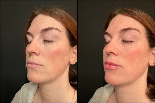 Dermal Fillers Case 20 - Lip Filler 