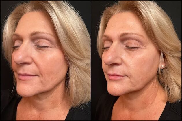 Dermal Fillers Case 22 - Smile Lines & Lips