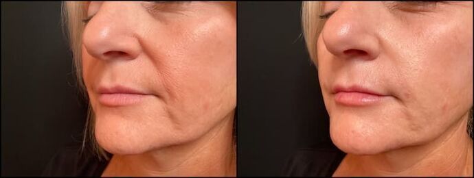 Dermal Fillers: Case 22 - Smile Lines & Lips - Before & After 