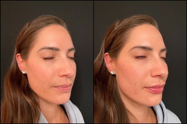 Fillers: Case 23 - Lip Filler - Before & After