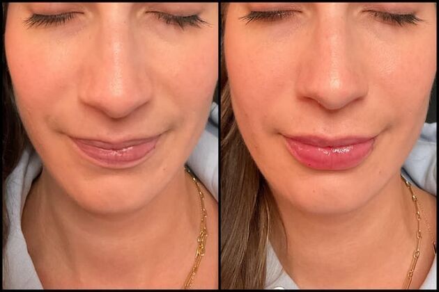 Fillers: Case 23 - Lip Filler - Before & After