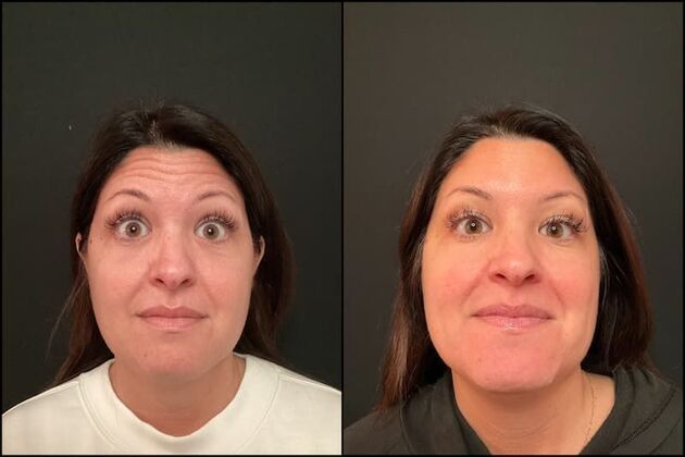 Xeomin (Botox Alternative) Case 4