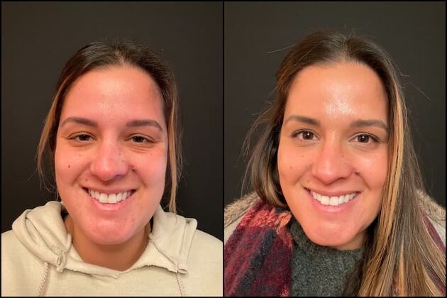 Xeomin (Botox Alternative) Case 2