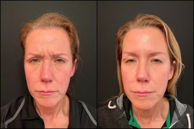 Xeomin (Botox Alternative): Case 3 - Before & After