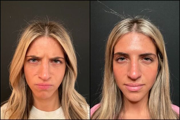 Xeomin (Botox Alternative): Case 1 - Xeomin - Before & After