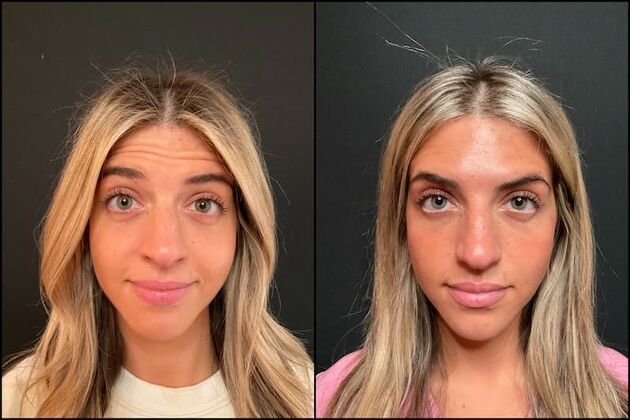 Xeomin (Botox Alternative) Cases