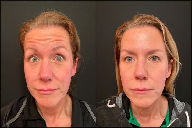 Xeomin (Botox Alternative) Case 3