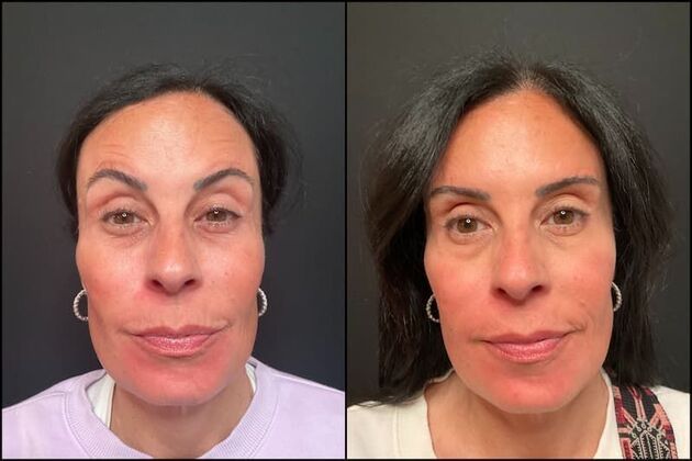 Xeomin (Botox Alternative) Case 5