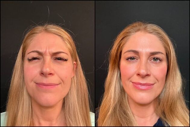 Xeomin (Botox Alternative) Case 6