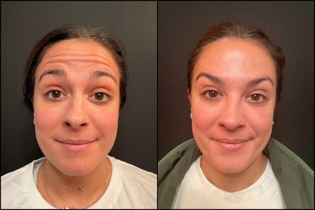 Xeomin (Botox Alternative) Case 7