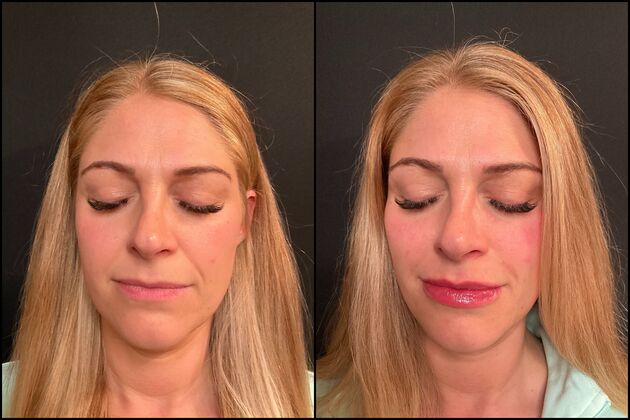 Dermal Fillers Cases