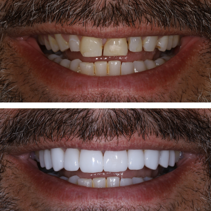 No Prep Porcelain Veneers Robert - Before