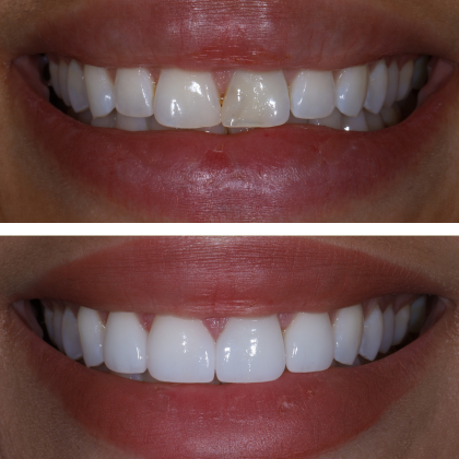 Minimal Prep Porcelain Veneers Melanie - Before