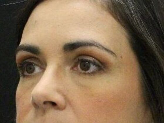 Eyelid Surgery: Case 20 - After