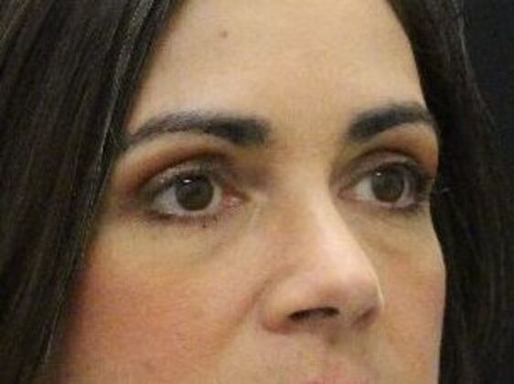 Eyelid Surgery: Case 20 - After