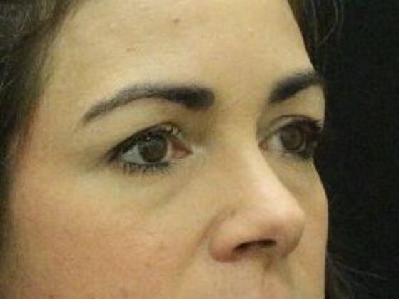 Eyelid Surgery: Case 20 - Before