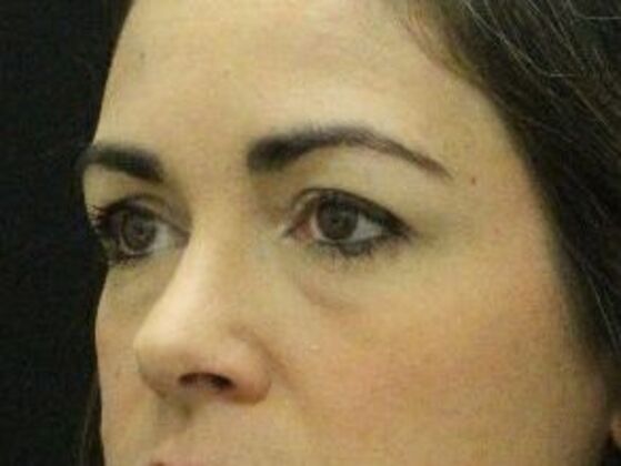 Eyelid Surgery: Case 20 - Before