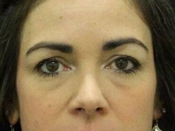 Eyelid Surgery Case 20 - Before